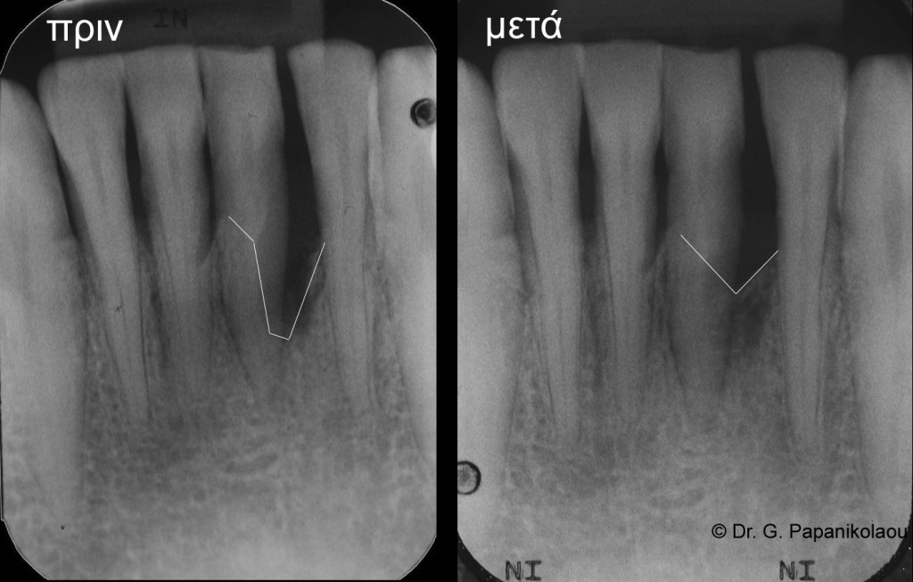10 μήνες αργότερα υπάρχει εμφανής αναγέννηση οστού και το δόντι μπορεί να σωθεί. 